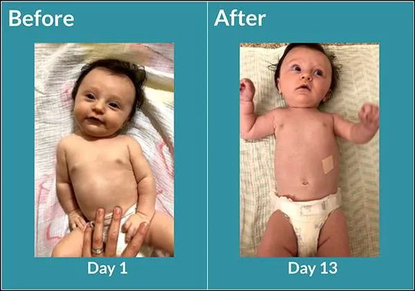 Infant with torticollis laying supine, differences in neck positioning seen 12 days apart.